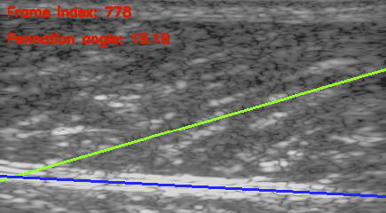 File:Ultrasound muscle pennation angle.PNG